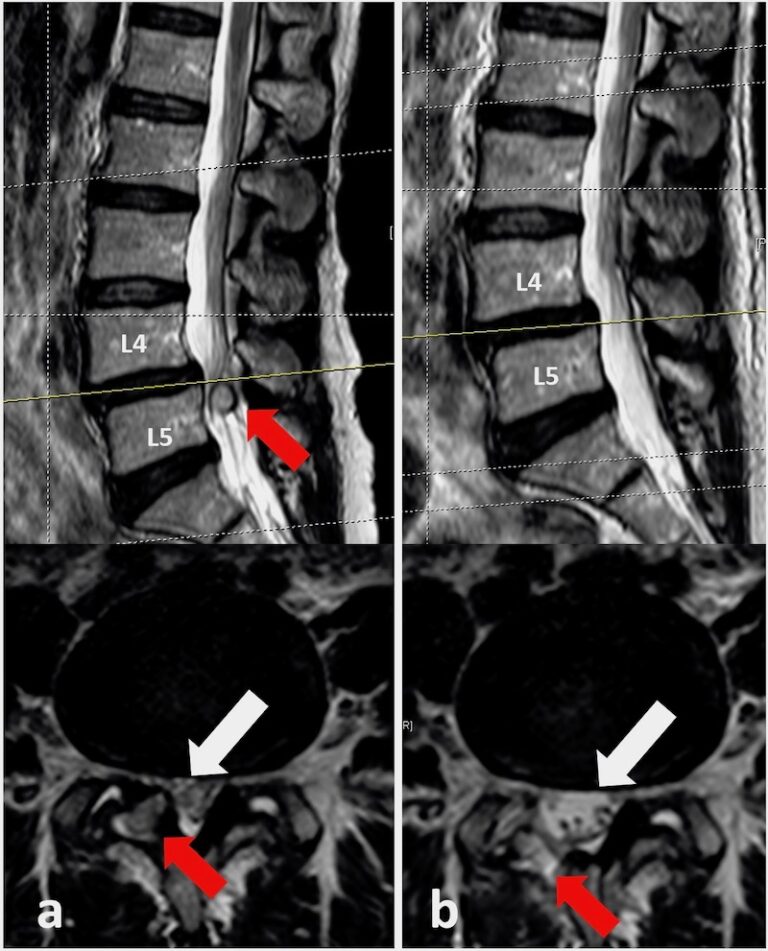 Synovialzyste der Lendenwirbelsäule Wirbelsäulenzentrum Zürich Hirslanden